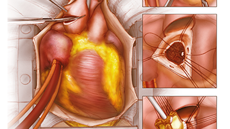 Aortic Valve Replacement