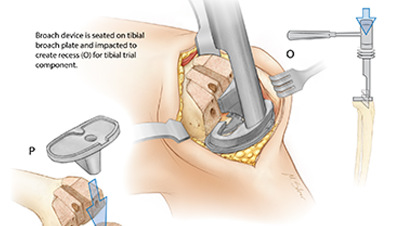 Total Knee Replacement