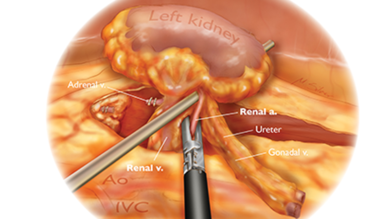 Nephrectomy