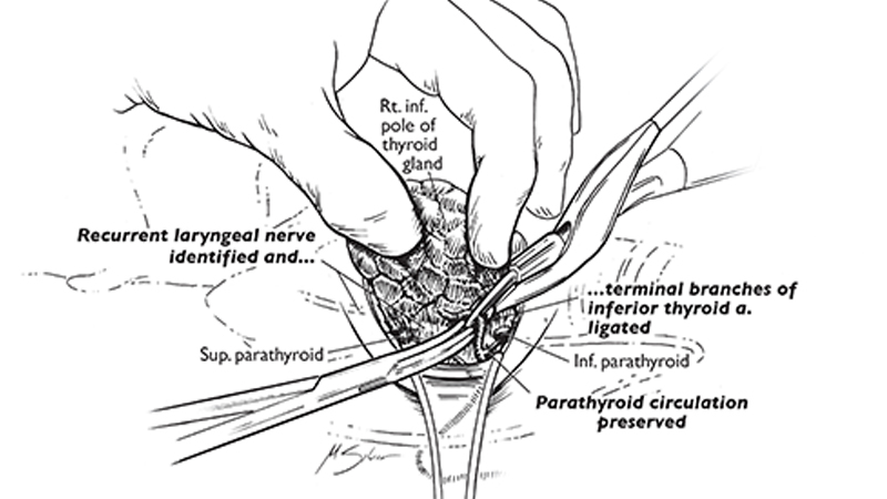 Thyroidectomy